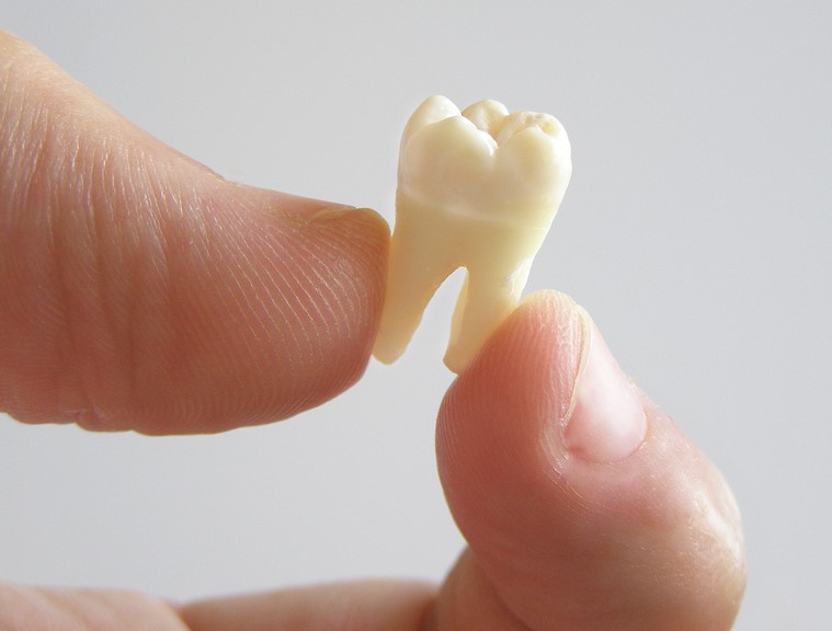 close up of hand holding molar tooth, Portland, OR tooth extractions