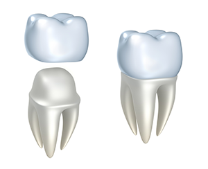 illustration of dental crown assembly, CEREC single visit dental crowns Portland, OR